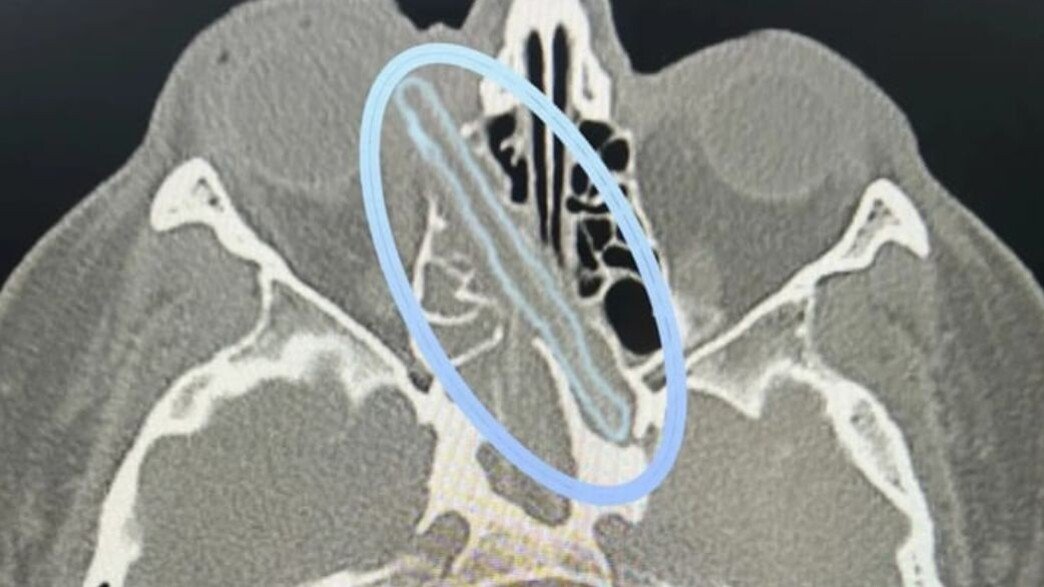 יורי מרוסיה חי עם ענף בעין 16 חודשים: מה גילו ב-MRI